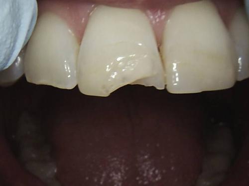 Dental Crowns Case 2 Before (1)