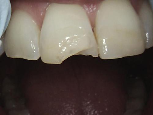 Dental Crowns Case 2 Before
