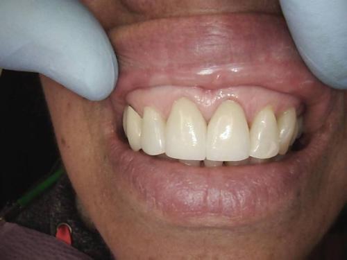 Dental Crowns Case 3 After p2
