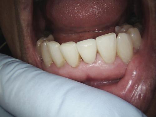 Dental Crowns Case 4 After p1