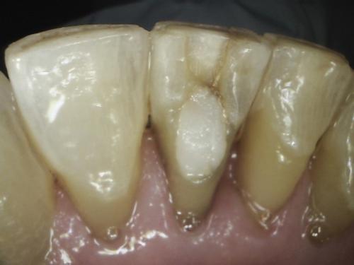 Dental Crowns Case 4 Before p2